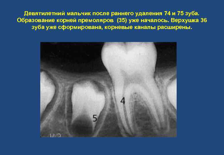 Девятилетний мальчик после раннего удаления 74 и 75 зуба. Образование корней премоляров (35) уже