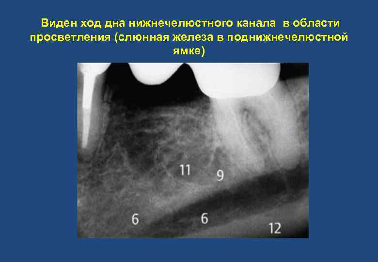 Виден ход дна нижнечелюстного канала в области просветления (слюнная железа в поднижнечелюстной ямке) 