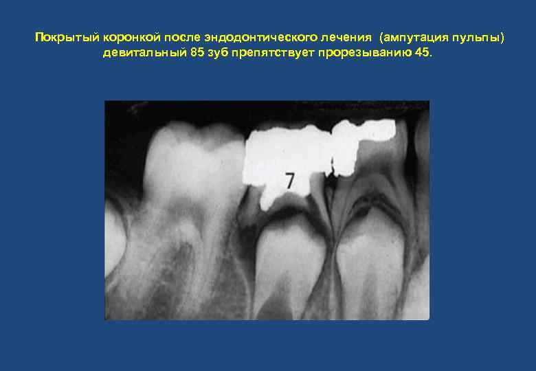 Покрытый коронкой после эндодонтического лечения (ампутация пульпы) девитальный 85 зуб препятствует прорезыванию 45. 
