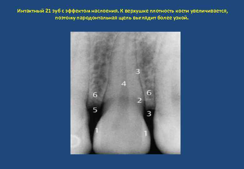 Интактный 21 зуб с эффектом наслоения. К верхушке плотность кости увеличивается, поэтому пародонтальная щель