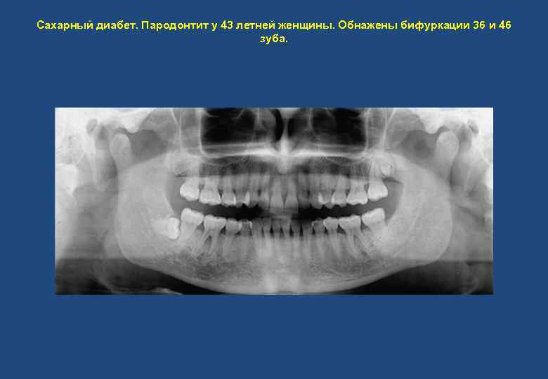 Сахарный диабет. Пародонтит у 43 летней женщины. Обнажены бифуркации 36 и 46 зуба. 