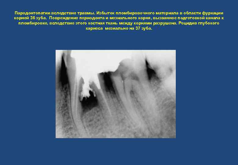 Пародонтопатии вследствие травмы. Избыток пломбировочного материала в области фуркации корней 36 зуба. Повреждение периодонта