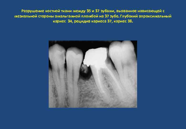 Разрушение костной ткани между 35 и 37 зубами, вызванное нависающей с мезиальной стороны амальгамной
