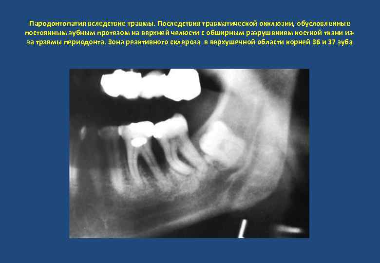 Пародонтопатия вследствие травмы. Последствия травматической окклюзии, обусловленные постоянным зубным протезом на верхней челюсти с