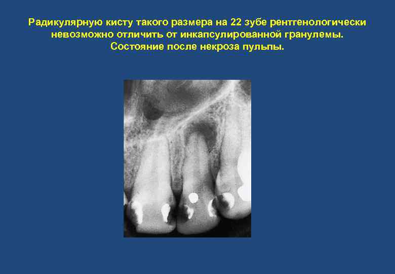Радикулярную кисту такого размера на 22 зубе рентгенологически невозможно отличить от инкапсулированной гранулемы. Состояние