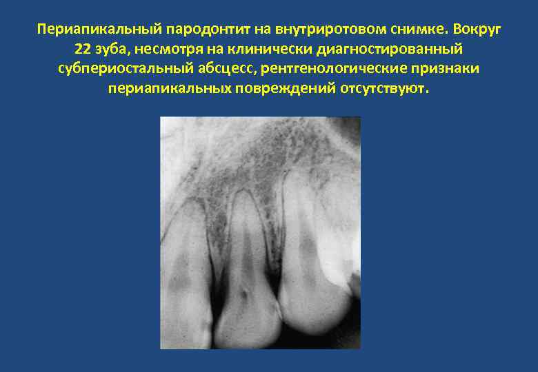 Периапикальный пародонтит на внутриротовом снимке. Вокруг 22 зуба, несмотря на клинически диагностированный субпериостальный абсцесс,