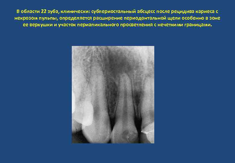 В области 22 зуба, клинически: субпериостальный абсцесс после рецидива кариеса с некрозом пульпы, определяется