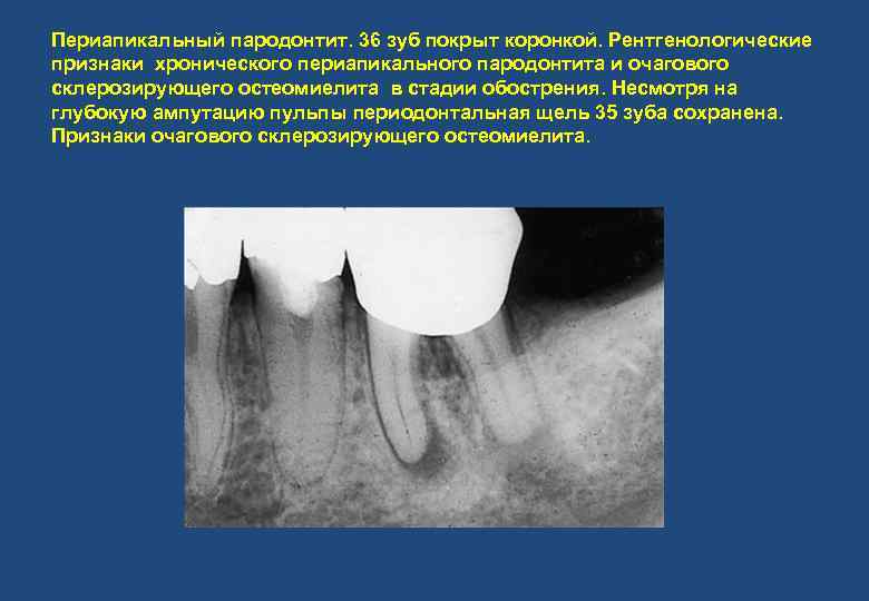 Периапикальный пародонтит. 36 зуб покрыт коронкой. Рентгенологические признаки хронического периапикального пародонтита и очагового склерозирующего