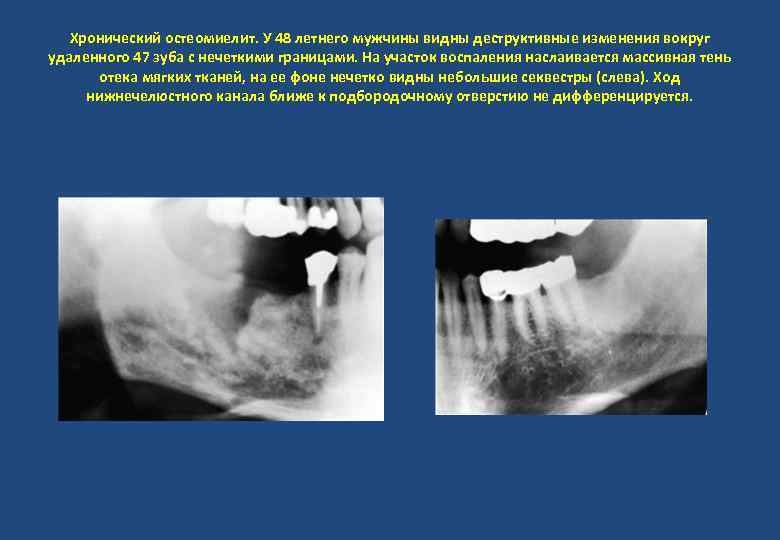 Хронический остеомиелит. У 48 летнего мужчины видны деструктивные изменения вокруг удаленного 47 зуба с