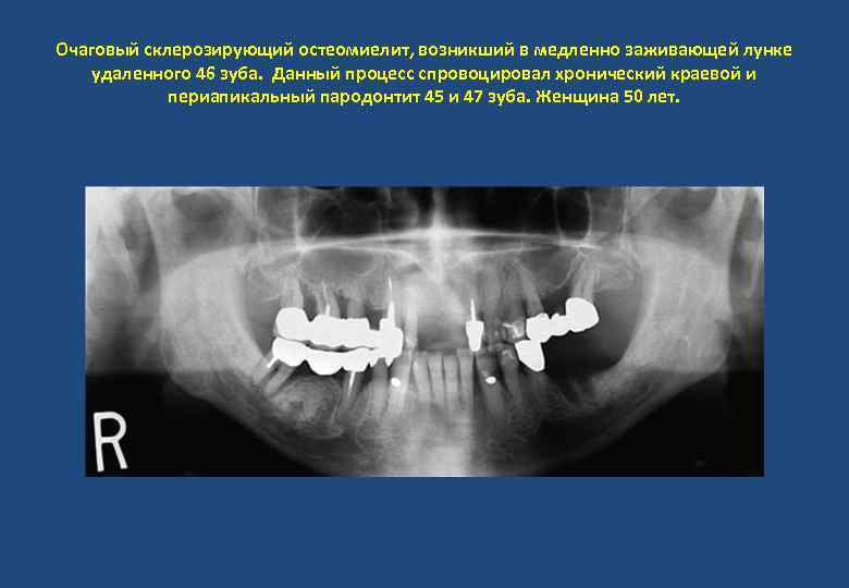Очаговый склерозирующий остеомиелит, возникший в медленно заживающей лунке удаленного 46 зуба. Данный процесс спровоцировал