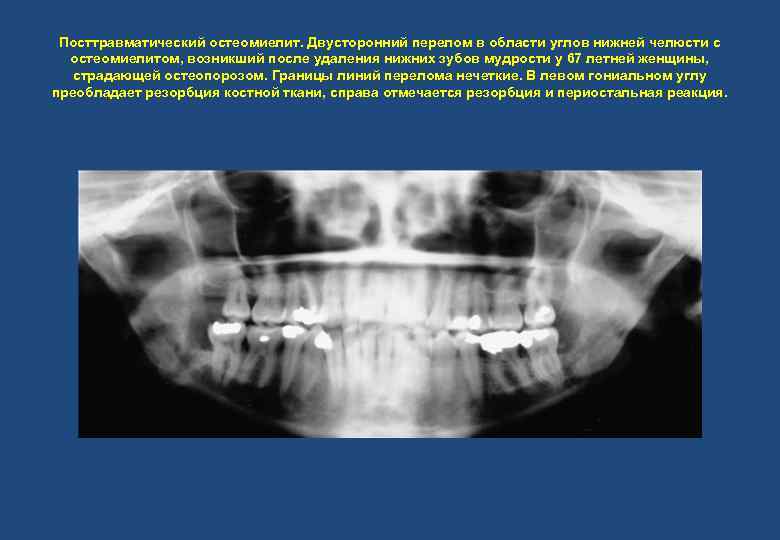 Посттравматический остеомиелит. Двусторонний перелом в области углов нижней челюсти с остеомиелитом, возникший после удаления