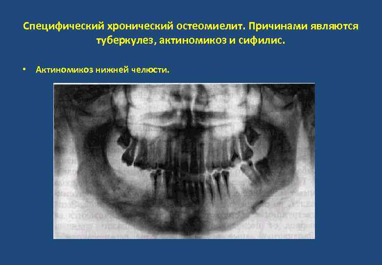 Специфический хронический остеомиелит. Причинами являются туберкулез, актиномикоз и сифилис. • Актиномикоз нижней челюсти. 