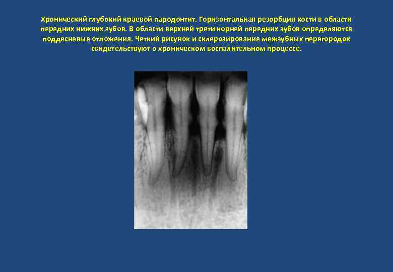 Хронический глубокий краевой пародонтит. Горизонтальная резорбция кости в области передних нижних зубов. В области