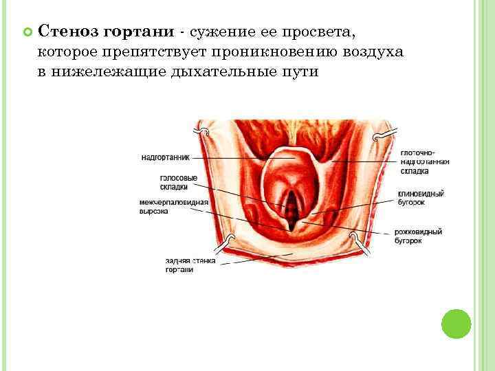  Стеноз гортани - сужение ее просвета, которое препятствует проникновению воздуха в нижележащие дыхательные