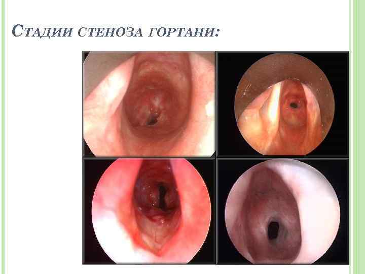 СТАДИИ СТЕНОЗА ГОРТАНИ: 