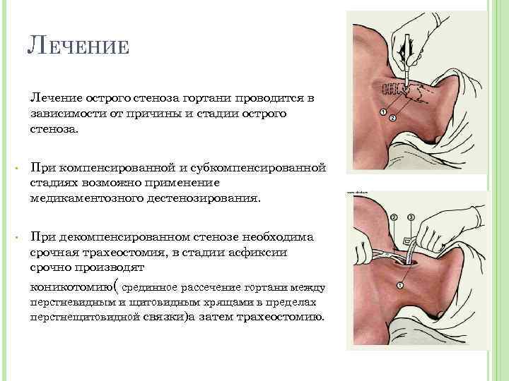 ЛЕЧЕНИЕ Лечение острого стеноза гортани проводится в зависимости от причины и стадии острого стеноза.