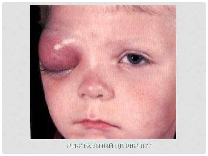 ОРБИТАЛЬНЫЙ ЦЕЛЛЮЛИТ 