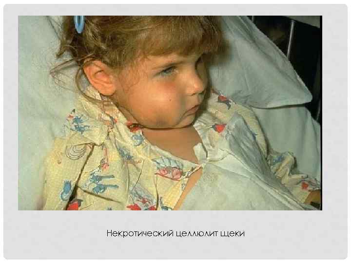 Некротический целлюлит щеки 