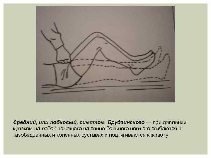 Средний, или лобковый, симптом Брудзинского — при давлении кулаком на лобок лежащего на спине