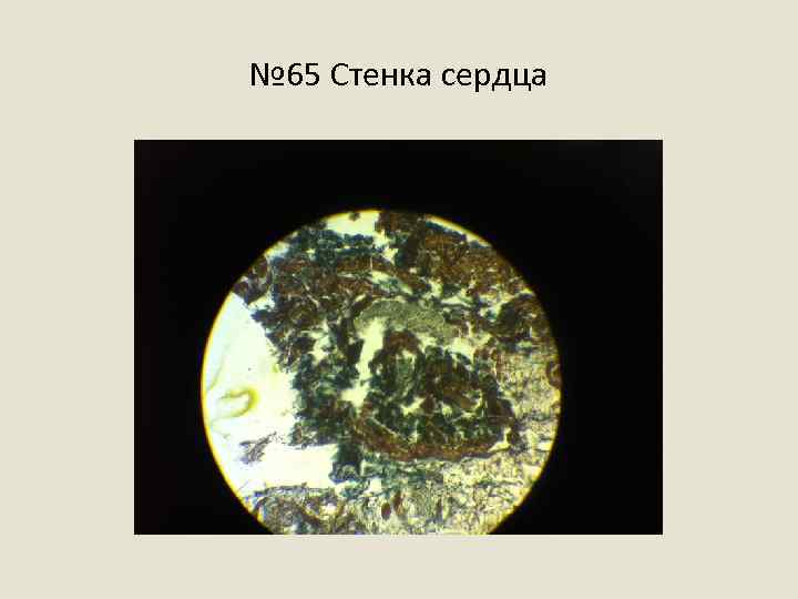 № 65 Стенка сердца 