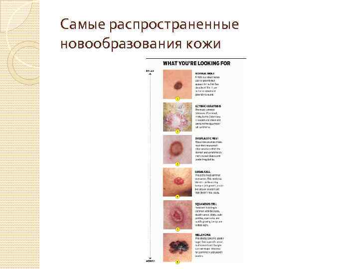 Самые распространенные новообразования кожи 