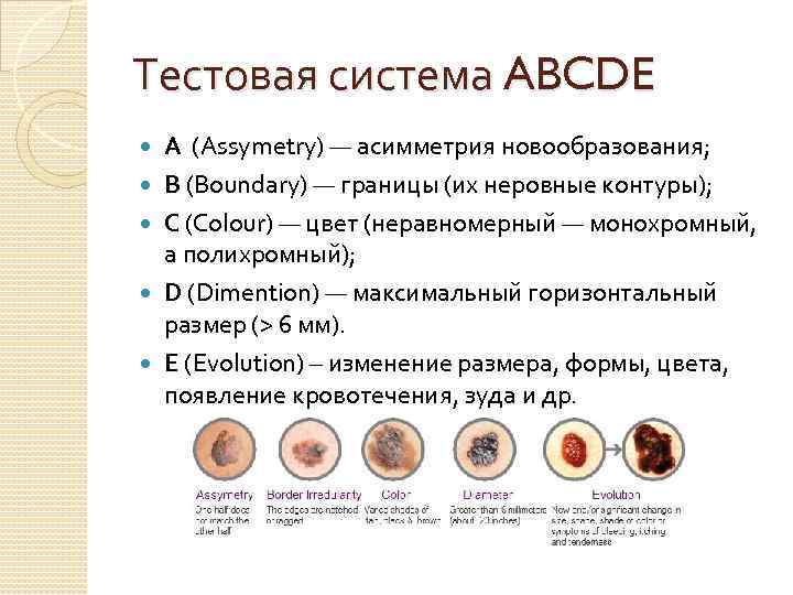 Тестовая система ABCDE А (Assymetry) — асимметрия новообразования; В (Boundary) — границы (их неровные