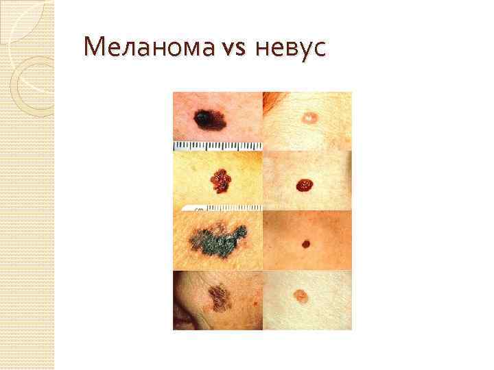 Меланома vs невус 