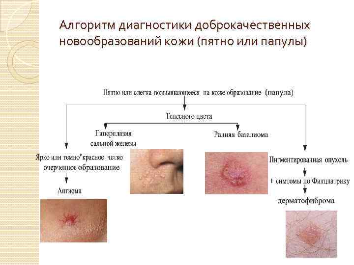 Алгоритм диагностики доброкачественных новообразований кожи (пятно или папулы) 