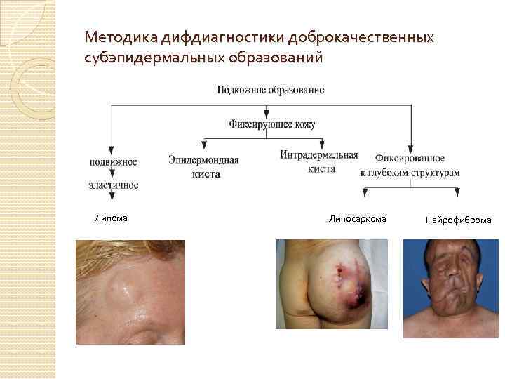 Методика дифдиагностики доброкачественных субэпидермальных образований Липома Липосаркома Нейрофиброма 