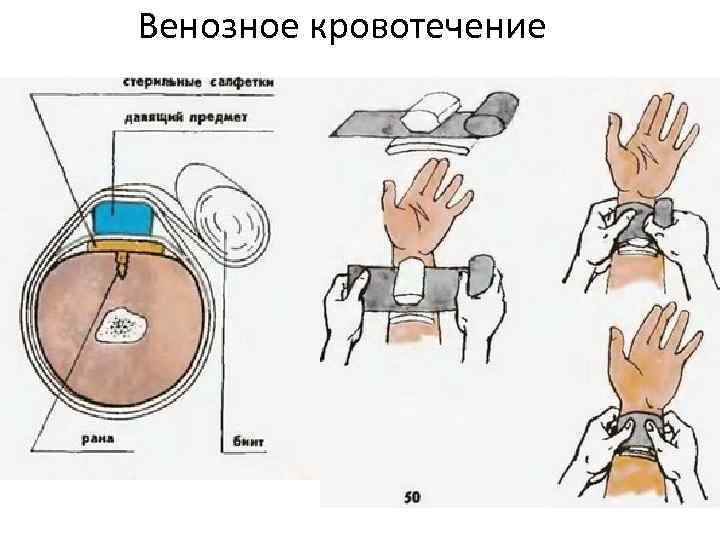 Венозное кровотечение 