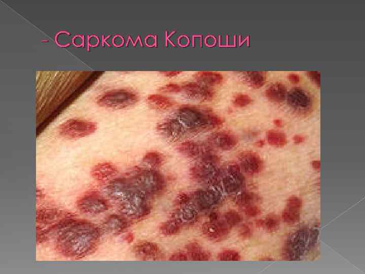 - Саркома Копоши 