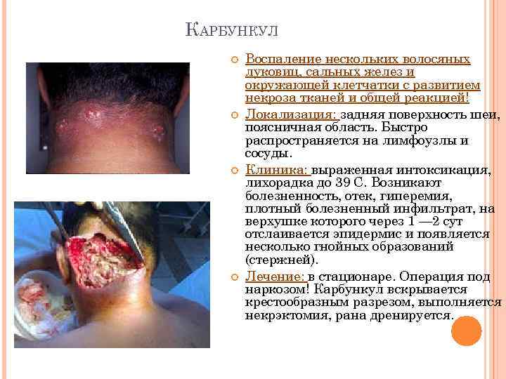 КАРБУНКУЛ Воспаление нескольких волосяных луковиц, сальных желез и окружающей клетчатки с развитием некроза тканей