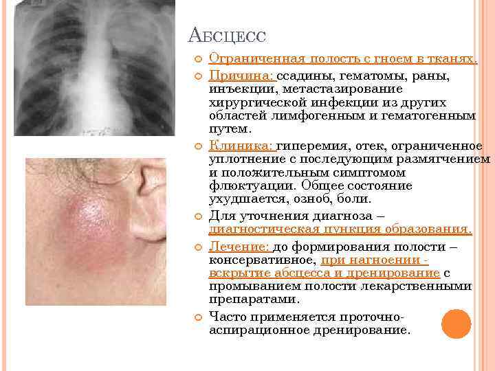 АБСЦЕСС Ограниченная полость с гноем в тканях. Причина: ссадины, гематомы, раны, инъекции, метастазирование хирургической