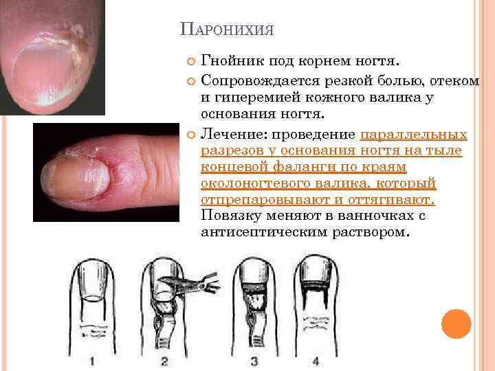 ПАРОНИХИЯ Гнойник под корнем ногтя. Сопровождается резкой болью, отеком и гиперемией кожного валика у