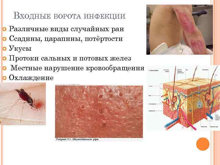 ВХОДНЫЕ ВОРОТА ИНФЕКЦИИ Различные виды случайных ран Ссадины, царапины, потёртости Укусы Протоки сальных и