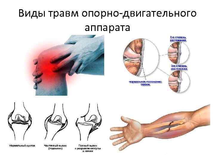 Виды травм опорно-двигательного аппарата 