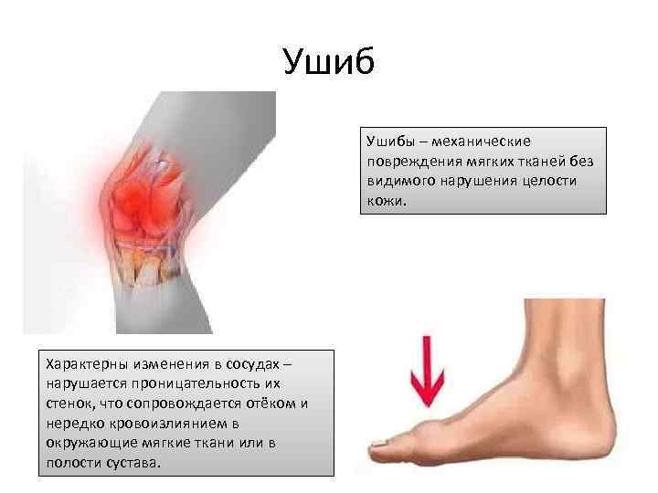 Ушибы – механические повреждения мягких тканей без видимого нарушения целости кожи. Характерны изменения в