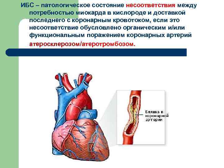 ИБС – патологическое состояние несоответствия между потребностью миокарда в кислороде и доставкой последнего с