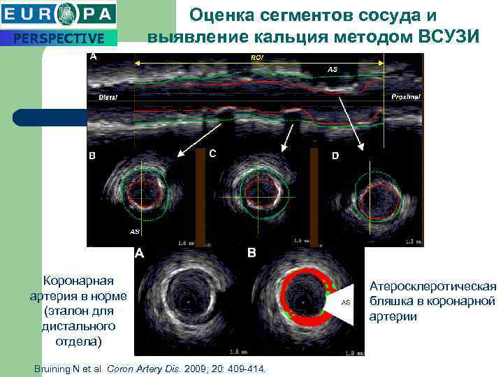 PERSPECTIVE Оценка сегментов сосуда и выявление кальция методом ВСУЗИ Коронарная артерия в норме (эталон