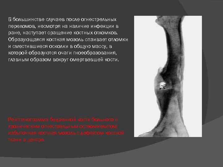 В большинстве случаев после огнестрельных переломов, несмотря на наличие инфекции в ране, наступает сращение