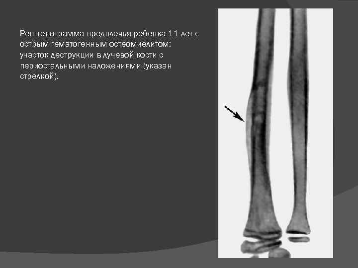 Рентгенограмма предплечья ребенка 11 лет с острым гематогенным остеомиелитом: участок деструкции в лучевой кости