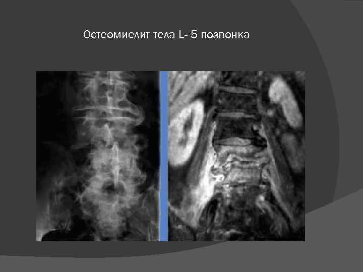 Остеомиелит тела L- 5 позвонка 