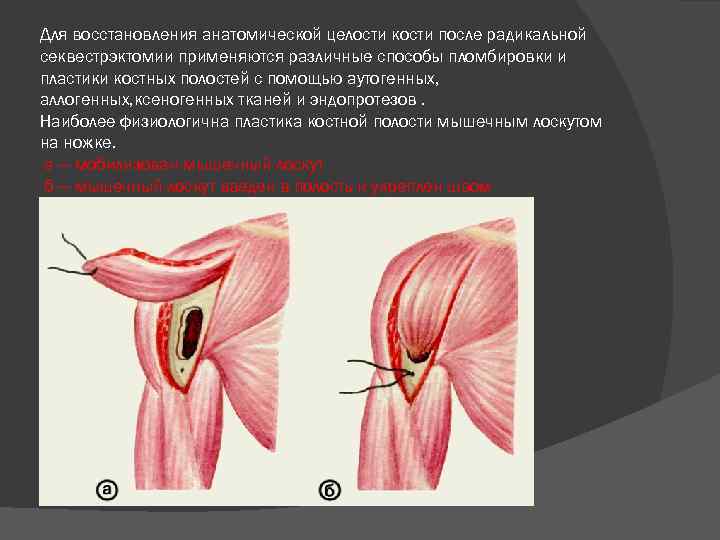 Для восстановления анатомической целости кости после радикальной секвестрэктомии применяются различные способы пломбировки и пластики