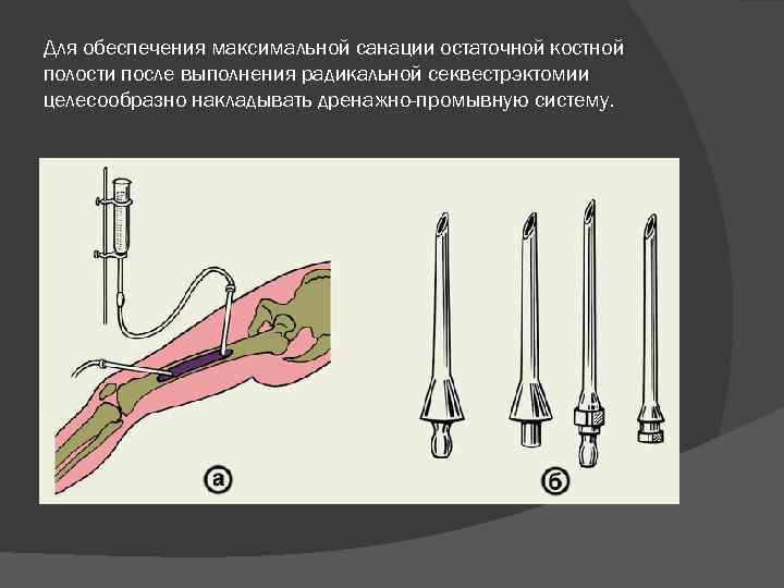 Для обеспечения максимальной санации остаточной костной полости после выполнения радикальной секвестрэктомии целесообразно накладывать дренажно-промывную