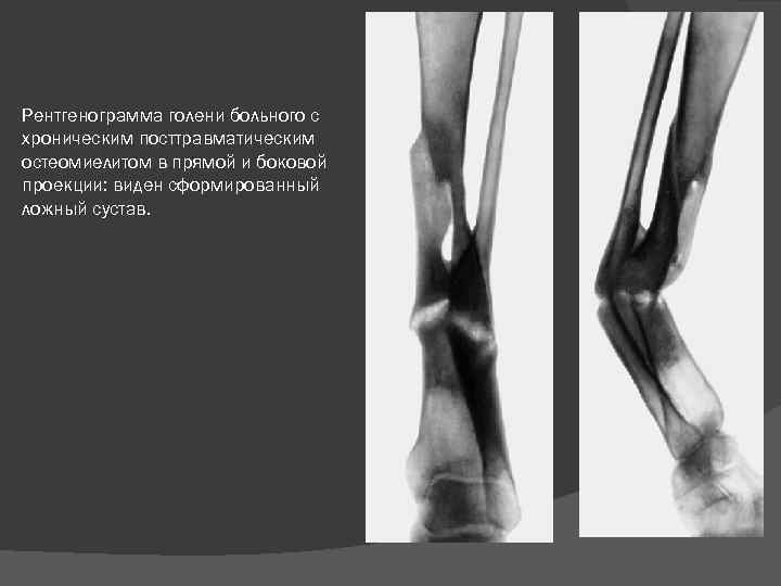 Рентгенограмма голени больного с хроническим посттравматическим остеомиелитом в прямой и боковой проекции: виден сформированный