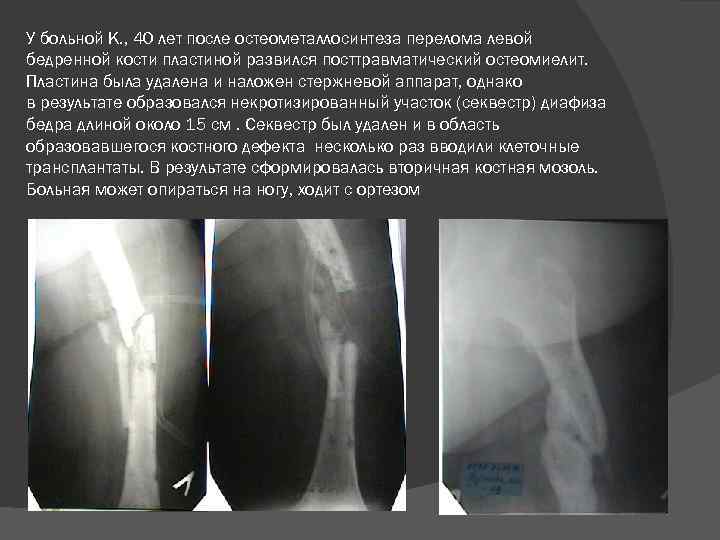 У больной К. , 40 лет после остеометаллосинтеза перелома левой бедренной кости пластиной развился