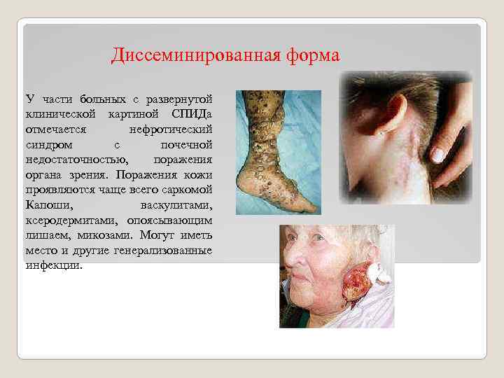 Диссеминированная форма У части больных с развернутой клинической картиной СПИДа отмечается нефротический синдром с