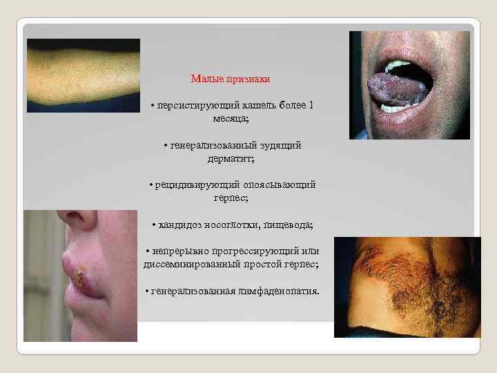 Малые признаки • персистирующий кашель более 1 месяца; • генерализованный зудящий дерматит; • рецидивирующий