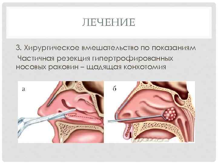 Нижняя подслизистая вазотомия. Конхотомия нижних носовых раковин. Гипертрофия слизистой носовых раковин. Эндоскопическая подслизистая вазотомия нижних носовых раковин. Эндоскопическая резекция средней носовой раковины что это.