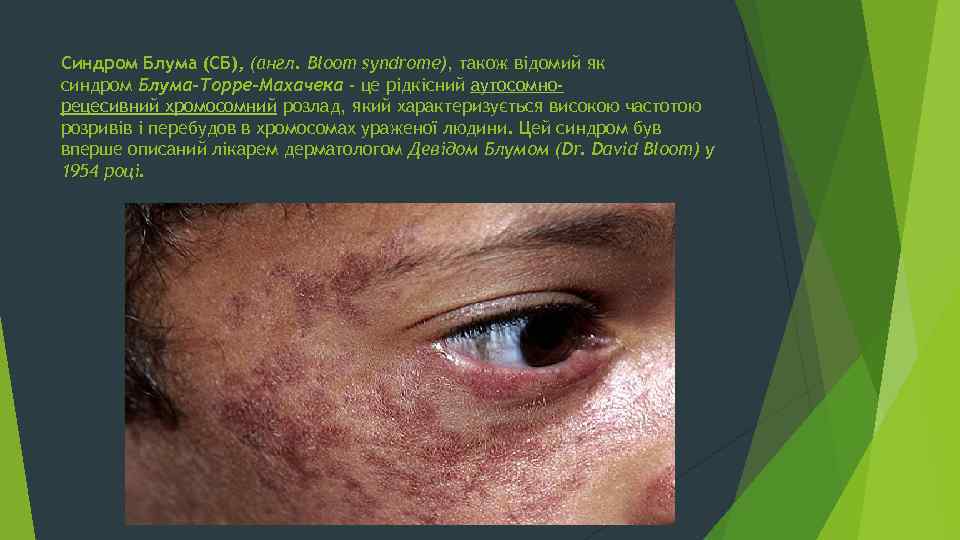 Синдром Блума (СБ), (англ. Bloom syndrome), також відомий як синдром Блума-Торре-Махачека - це рідкісний